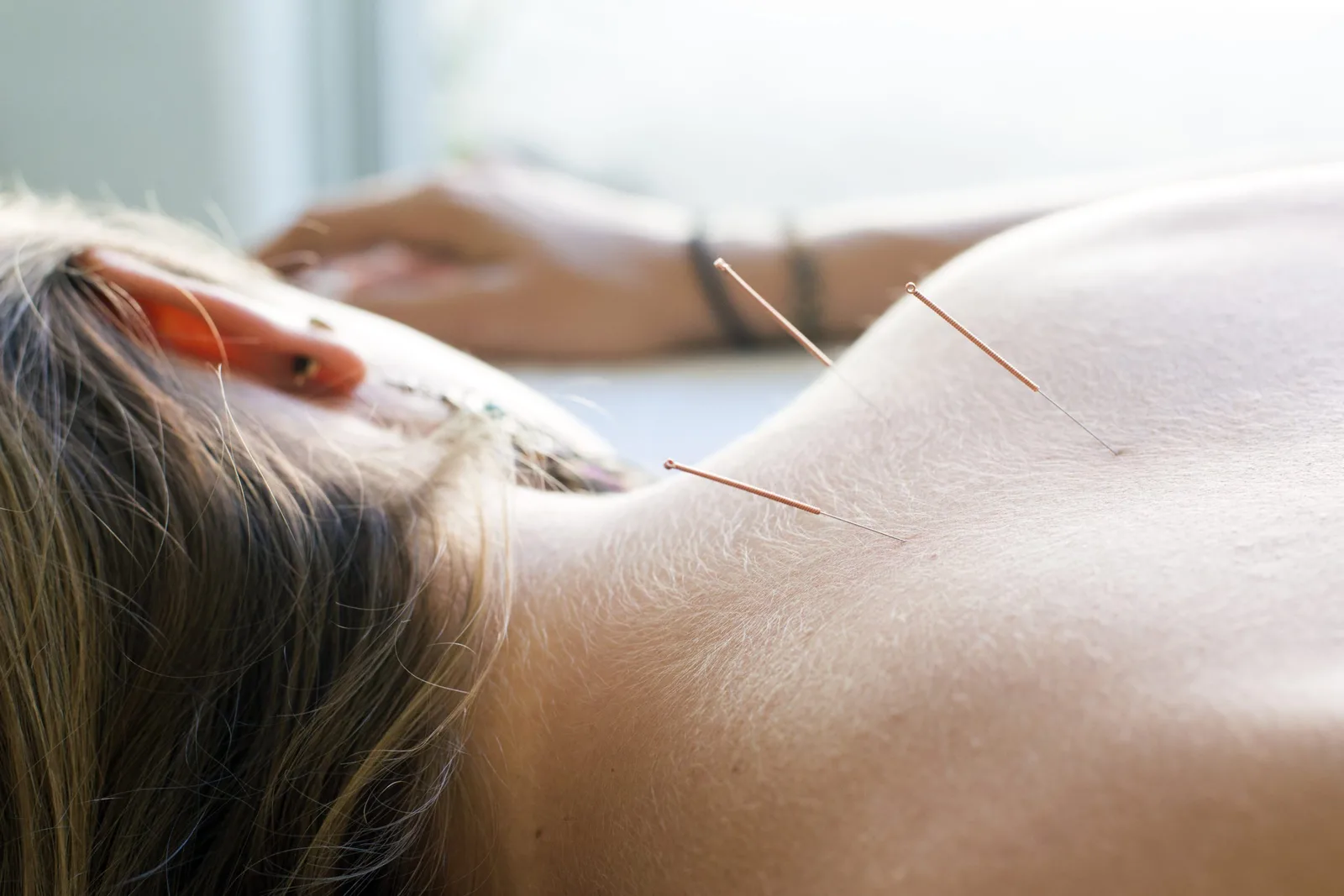 Acupuncture session — needles on shoulder