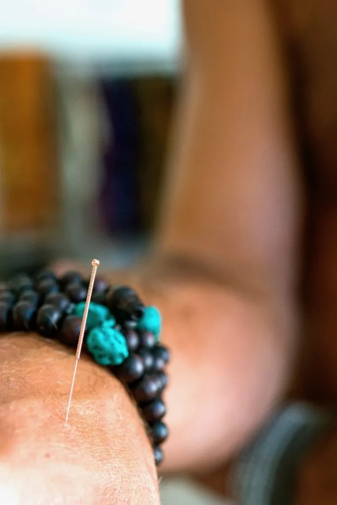 Acupuncture & cupping — Tobias's table